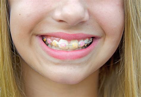 best colors for clear braces.